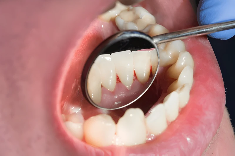 علائم سرطان دهان و لثه