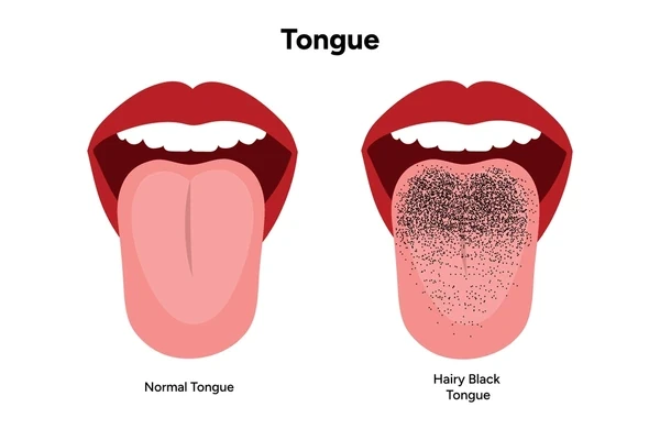 عکس زبان مودار